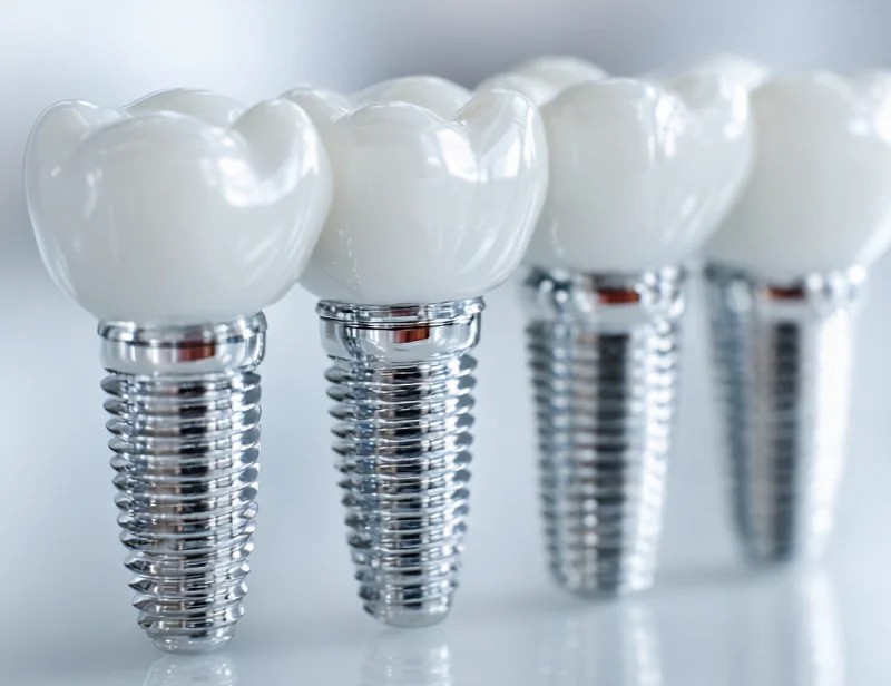 Имплантация All-on-4 и All-on-6