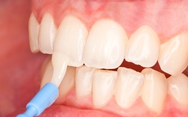 Чувствительные зубы, лечение